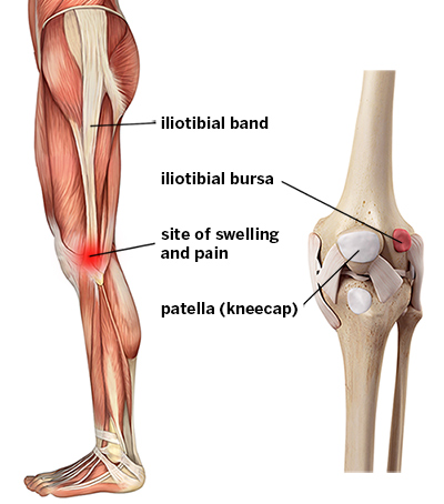 Iliotibial Band Syndrome (ITB Syndrome)