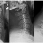 Whiplash injury