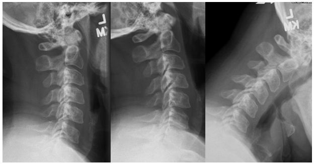 Whiplash injury